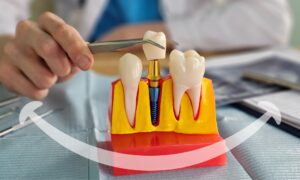Dental implants restore missing teeth.